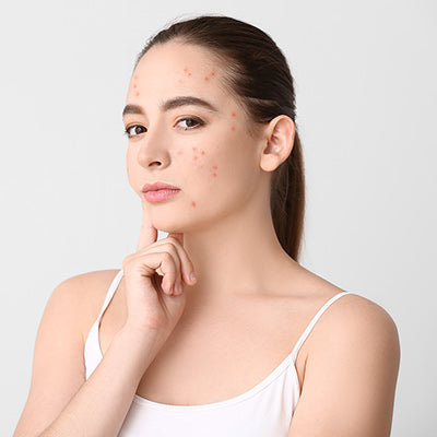 Does Acne Get Worse Before it Gets Better?
