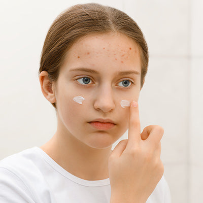 Is Acne Cream Supposed to Burn? An Investigative Piece