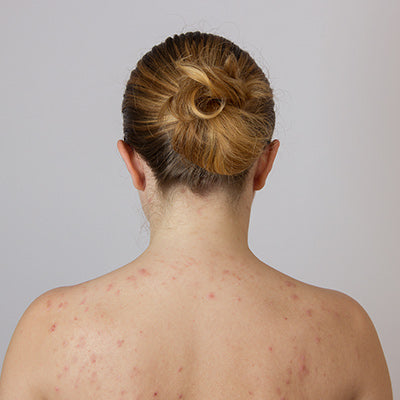Shoulder Acne - Important Things You Ought to Know