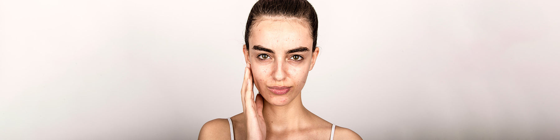 What is the Right Way to Treat Acne?