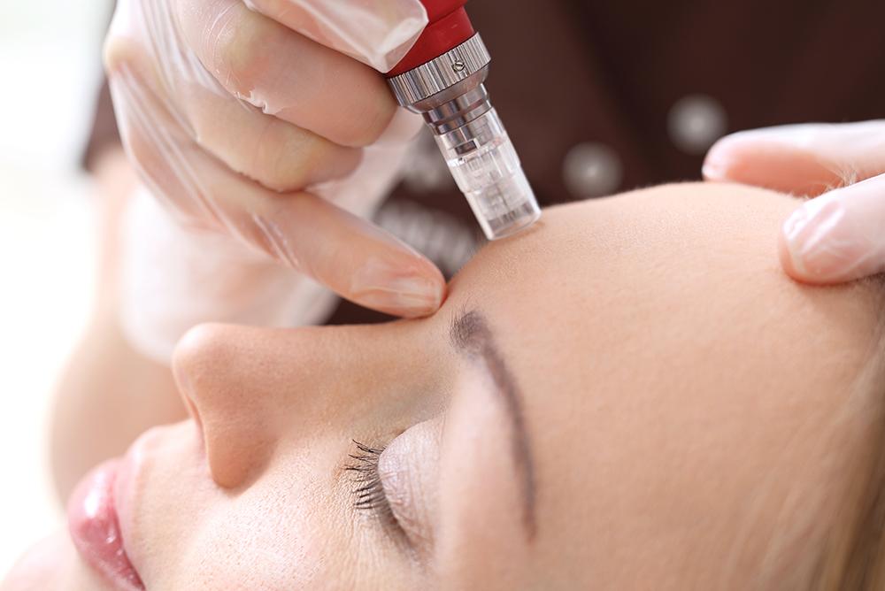 microneedling para cicatrices de acne