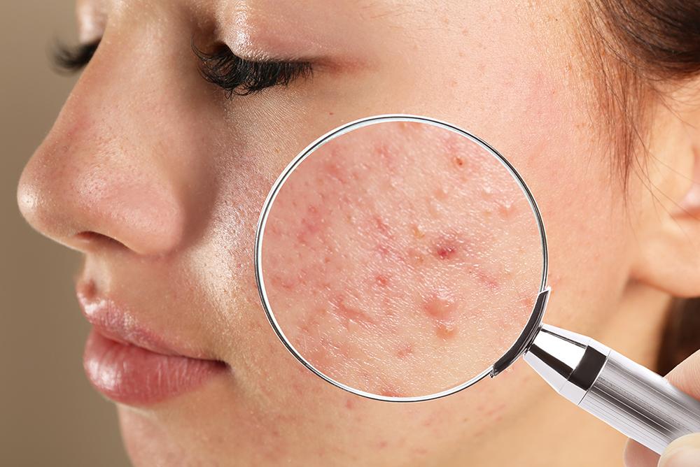 tipos de cicatrices de acne
