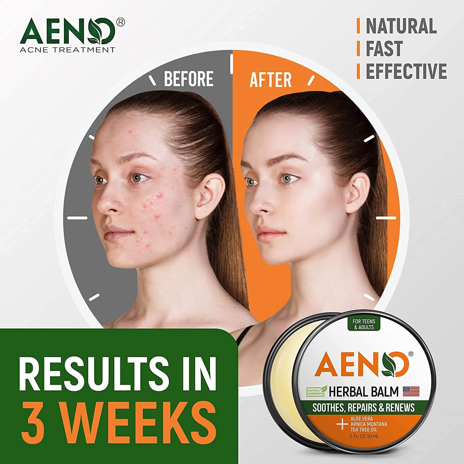 holistic cystic acne treatment